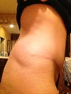 Indentation from lipo.
