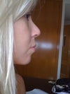 This is the photo after the first rhinoplasty.