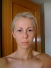 This is also the photo after the first rhinoplasty.