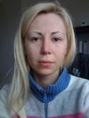This is the photo immediately after the second rhinoplasty.