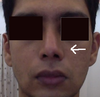 Front view, the uneven nostril is pointed to with an arrow