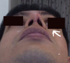 Up view, the uneven nostril is pointed to with an arrow