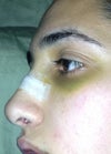 the new side of my nose