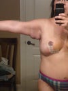 This is after my doctor drained it last week. Will it get better?