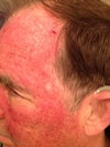 12 days above beardline, 6 days below beardline. Note pale spot where mole was removed 4-5 years earlier