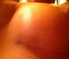 Bruising