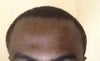 Forehead dent