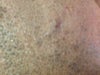 iphone picture so it's not very clear

the scar is bound down. it's not a keloid or hypertrophic. the damage done is underneath. i can stretch it in ways to make it appear almost normal (pre-injury). i was thinking subcision with a filler or simply a filler (with repeat trips when the filler wears off) would help.
