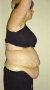 The day I went into have my full tummy tuck. weight 235 pounds