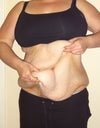The day I went into have my full tummy tuck. weight 235 pounds