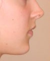 after chin and nose