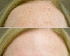Pixel Laser Before and After Photos