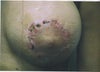 Healing was like this after main procedure and after revision on both areolas