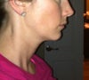 Side profile. Did TMJ and extractions cause weak chin?