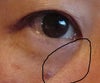 height difference in lower inner eyelid corner