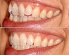 Invisalign Before and After Photos