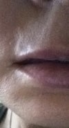 Restylane migration above upper corner of vermillion/upper lip