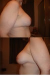 3.5 weeks post-op