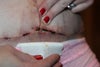 This is post operation day 19. It started 2 days ago with a little pus and now it is open with a white cream cheese looking substance in the incision.