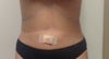 Day after post op pic