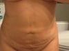 3 days post op