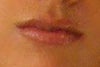 before any lip filler