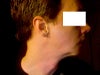Left side which is less, but still bothersome
