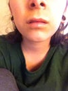 one side of my lip is higher than the other