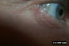 This is a photo of the horrible swelling, and wrinkling, that formed in my lower eyelids that is a result of Juvederm migrated there. It is the worst in the morning.  I've found out, from doctors responses, on RealSelf, that Hyaluronidase can be injected in the lower eyelids to remove the Juvederm. It seems like it should be pretty easy from the comments I've read from doctors and plastic surgeons.  If a doctor is willing to treat me I would greatly appreciate it if you would contact me with a response. Thank You.
