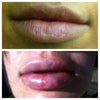 Lips right before operation and right after