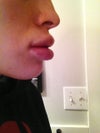 morning after operation, shows the swelling better than front view