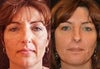 Skin Rejuvenation Before and After Photos