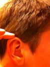 Right Ear with visible ridge.