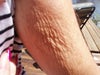 Upper arm bicep area
