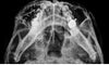 The fracture is the part marked with the pen (the only copy of the x-ray I have is this one)