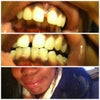 Since my teeth push out so far it makes my chin look weird :(