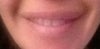 14 months after juvederm