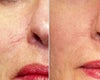 V Beam Before and After Photos