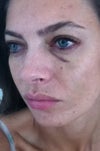 2 days after the Juvederm injection