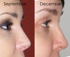 1. Nose in September, one week post-op (17/09/2012) 2. Nose in December, (19/12/2012)