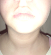 Chubby chin, chubby cheeks, although I just recently went from underweight to normal.