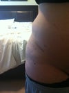 Right side where my lump is forming