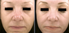 ProFractional Laser before & after photos