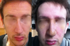 7 days post rhinoplasty