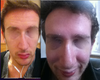 10 days post rhinoplasty (bad angle)