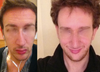 10 days post rhinoplasty (better angle)