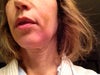 jowl from too much Radiesse?
