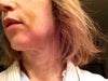 jowl from Radiesse or is it due to swelling?