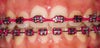 elastomeric chains on upper teeth