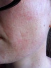 Right side of face relaxed, see line is very deep-it was not a severe line like that before the first peel